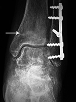 Left ankle stress fracture