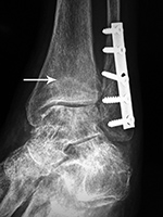 Left ankle stress fracture