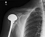 Right shoulder hemiarthroplasty loosening