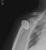Rt shoulder hemiarthroplasty