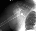 Comminuted fracture dislocation of right humeral head
