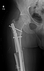 Hypertrophic nonunion initial image