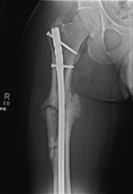 Hypertrophic nonunion partial healing