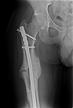 Hypertrophic nonunion full healing