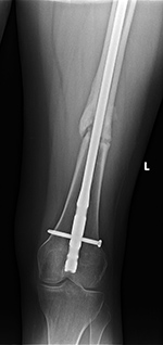 Femur hypertrophic nonunion