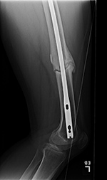 Femur hypertrophic nonunion