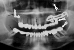 Dental implant fixed bridge