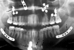 Dental bone, plates, and screws