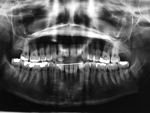 Permanent mandibular retainer