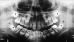 Stages of dentition
