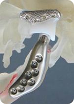 TMJ prosthesis