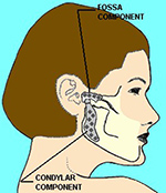 TMJ prosthesis