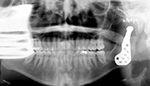 TMJ prosthesis