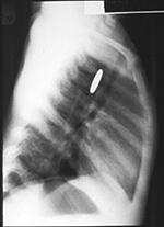 Coin in esophagus