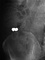 Dental filling in bowel