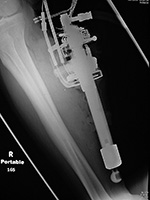 Firehose injury
