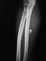Glass in forearm