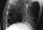 Mercury in the chest