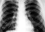 Mercury in the chest