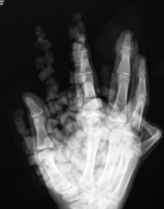 Ice bag on the hand
