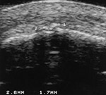 Knee calcifications on US