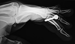 Left index finger nail gun injury