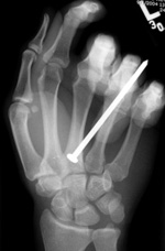 Nail gun injury