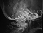 Pantopaque in the skull