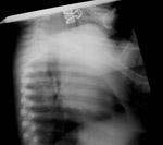 Paper clasp in hypopharynx