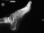 Pen in foot