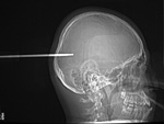 Screwdriver in skull