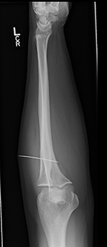 Sewing needle in forearm