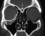 "Shear injury" after surgical repair of the right orbital floor