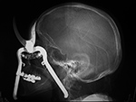"Shear injury" lateral view