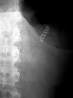 Toothbrush in the stomach
