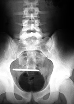 Broken rectal thermometer