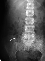 Tongue ring in bowel