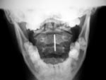 Tongue ring