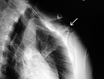 Toothbrush in left chest wall