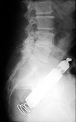 Traffic wand in rectum