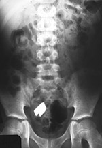 Tweezer in bowel