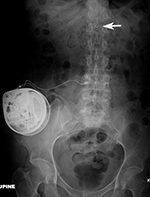 Baclofen intrathecal pump AP view