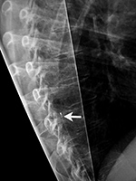 Baclofen intrathecal pump lateral view