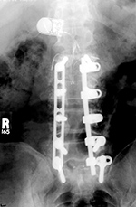 Bone stimulator