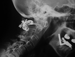 Posterior cervical spinal clamp