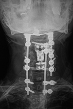 Cervical spine fusion and corpectomy cage at C4-5