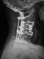 Cervical spine fusion and corpectomy cage at C4-5