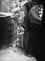 Cervical disk cages