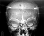 Head tongs AP view