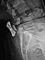 X-Stop device